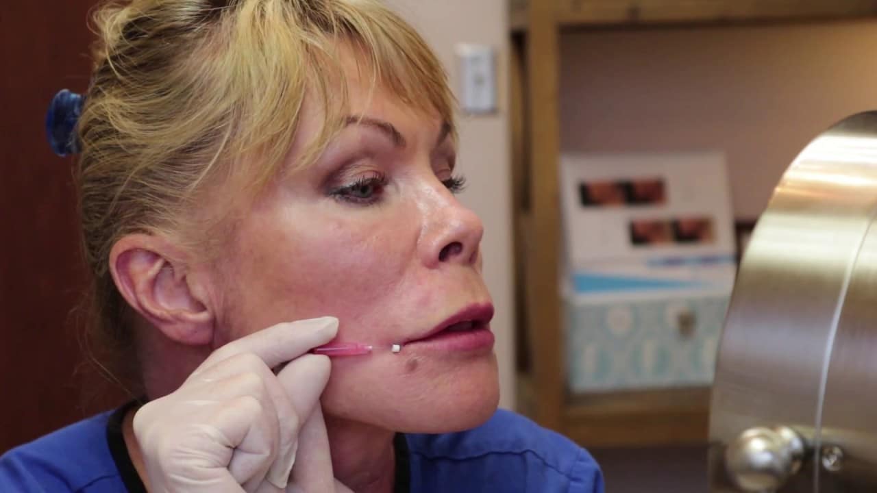 A demonstration of absorbable face threads to define the lips