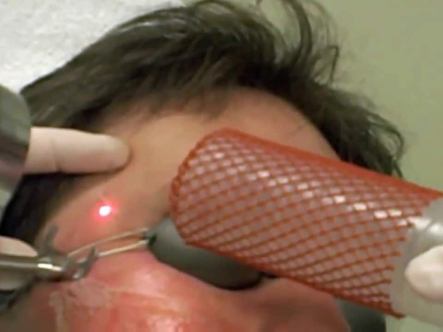 A fractionated laser resurfacing treatment on acne scars