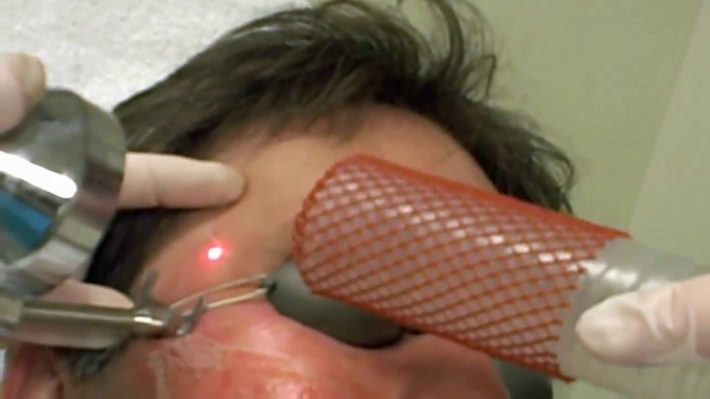 Profractional laser scar treatment at Skinspirations in Tampa Bay