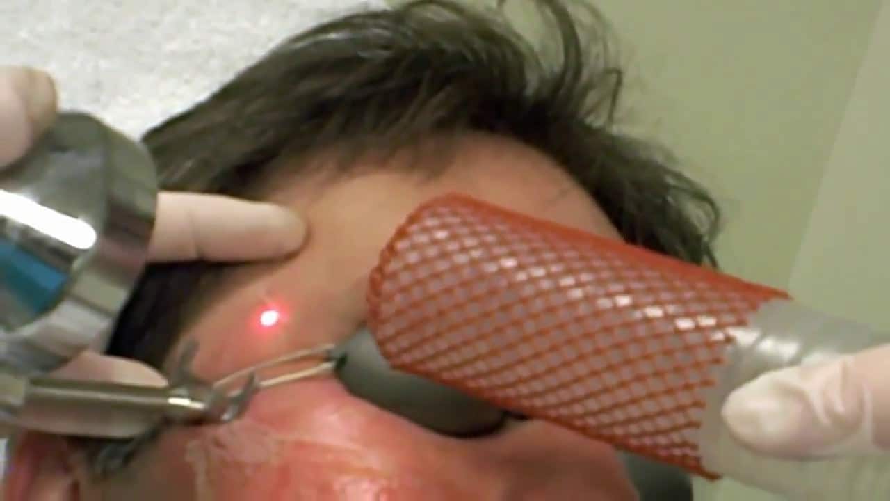 A fractionated laser resurfacing treatment on acne scars