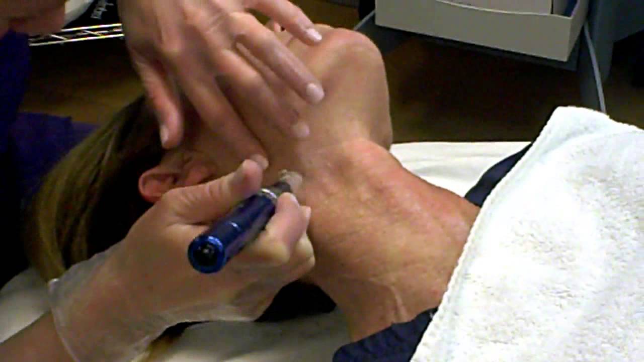 Demonstration of Skinpen microneedling of the neck
