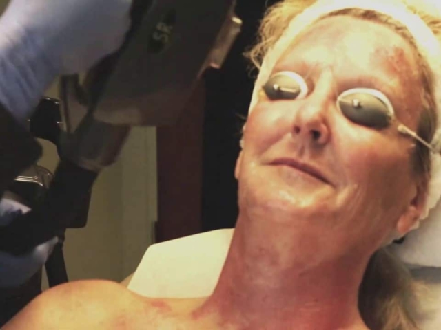 An IPL (Intense Pulsed Light) Photofacial