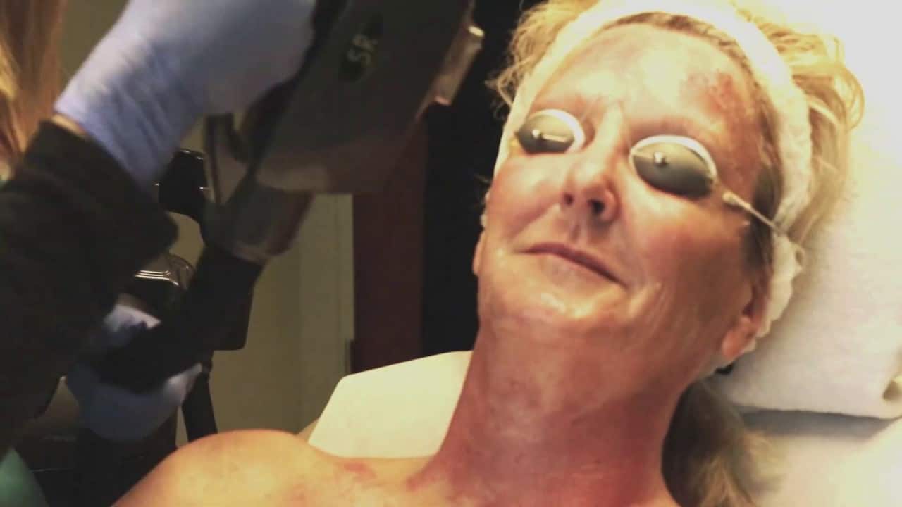 An IPL (Intense Pulsed Light) Photofacial