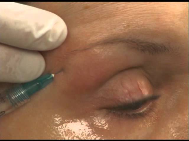 Using dermal filler to provide a brow lift