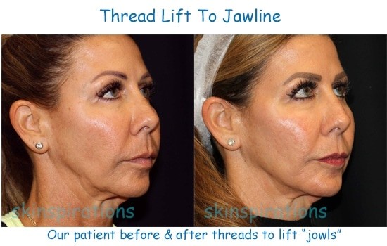 Before and after thread lift of jawline