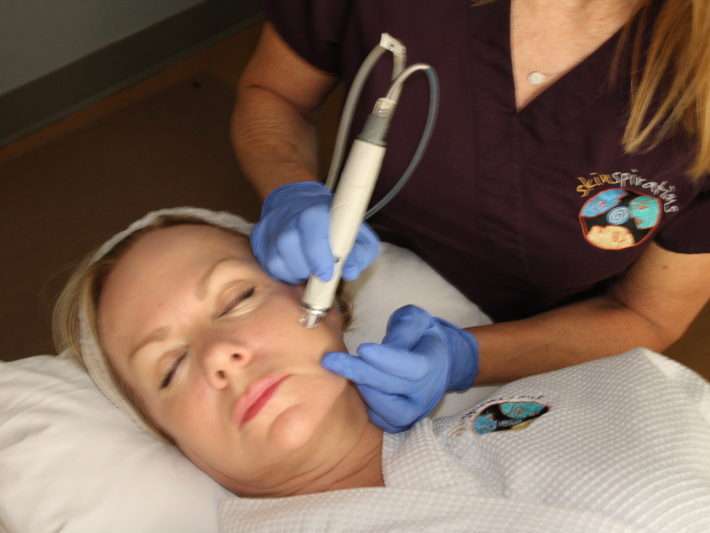 Closeup photo of a microdermabrasion treatment at Skinspirations