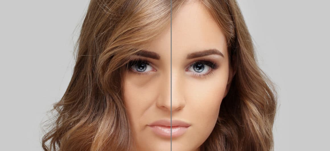 woman's face before and after injectable dermal filler makeover