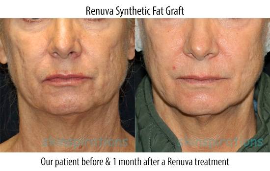 Renuva fat graft before and after photos