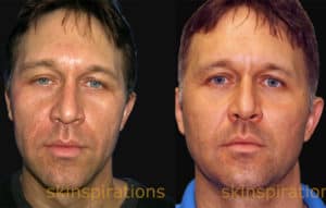 An illustration of how esthetic treatments of the face change the implied personality 