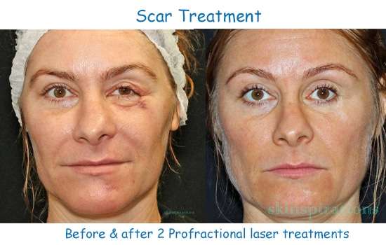 A contracted scar of the eyelids before & after laser