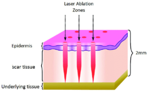 fractionated laser effects on scar diagram