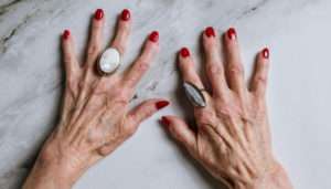Aging hands before treatment at Skinspirations