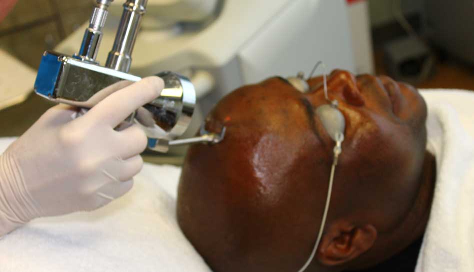 Laser scar treatment on the face at Skinspirations in Tampa BAy